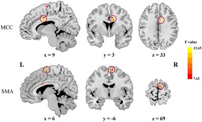 Frequency characteristics of temporal and spatial concordance among dynamic indices in inattentive and combined subtypes of attention deficit hyperactivity disorder